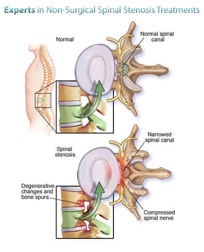 Spinal Stenosis Specialists Doctors in NYC