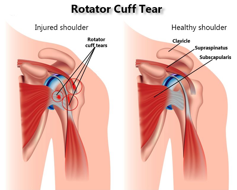 Rotator Cuff Tear Treatment Specialists In NYC New York Pain Care