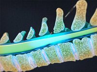 Lumbar Epidural Steroid Injections