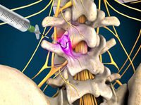 Medial Branch Nerve Block