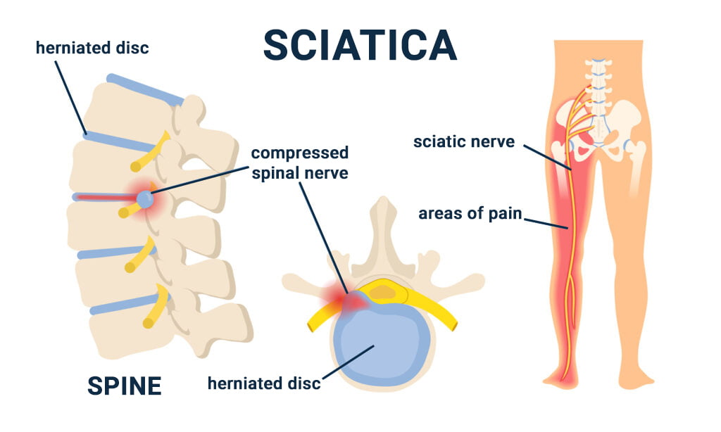 What Causes Lower Back Pain And Hip Pain On One Side 