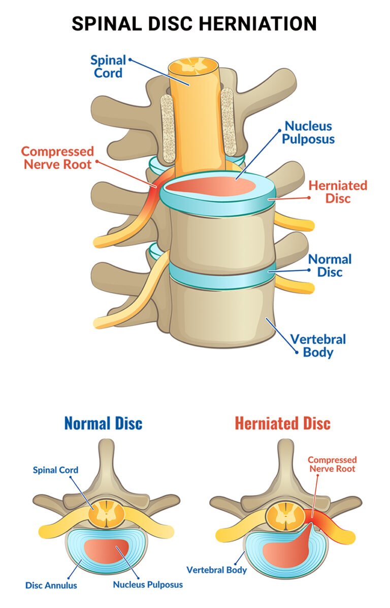 Can Herniated Disc Cause Constipation?