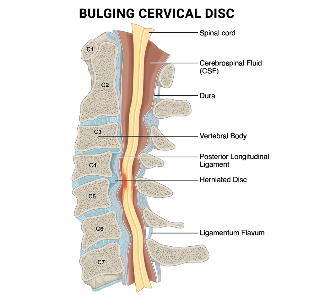 Can A Chiropractor Help With A Bulging Disc | New York Pain Care