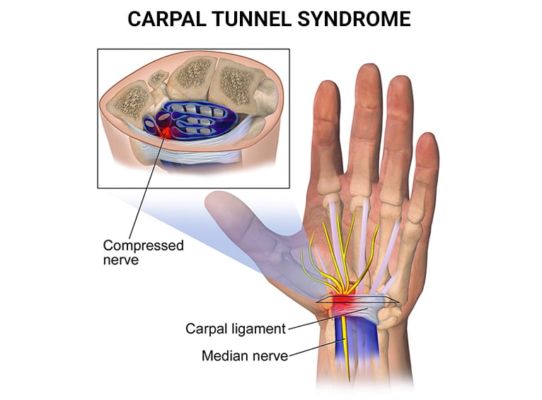 Carpal Tunnel Syndrome Treatment NYC Hand Pain In New York