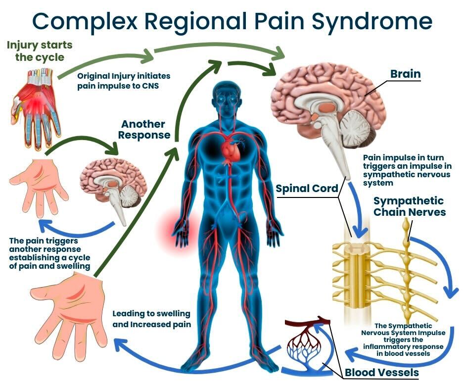 CRPS Specialist NYC | Complex Regional Pain Syndrome Treatment